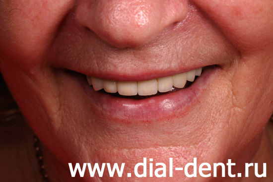 результат лечения и протезирования зубов в Диал-Дент