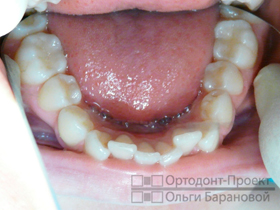 нижние зубы до лечения у ортодонта