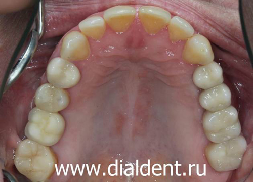 верхние зубы после комплексного лечения и протезирования 