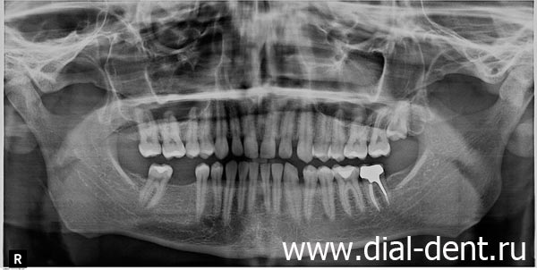 панорамный снимок зубов до имплантации