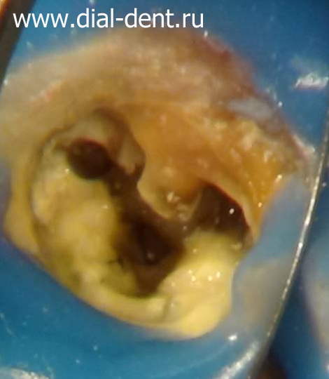 лечение каналов зубов под микроскопом