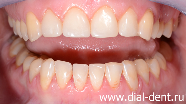 реставрация передних зубов, удаление зубов мудрости, имплантация и протезирование жевательного зуба