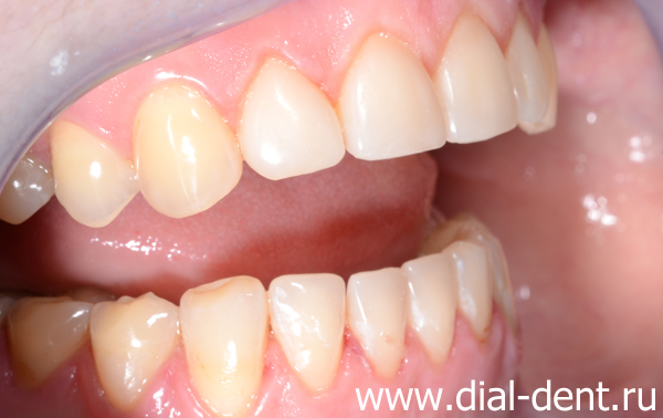 результат комплексного лечения зубов в Диал-Дент