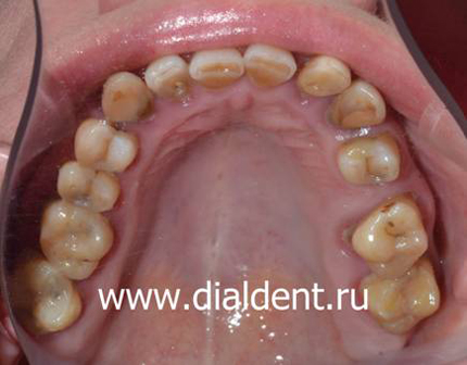 верхние зубы до лечения и протезирования