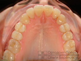 верхние зубы после лечения у ортодонта