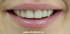 улыбка после лечения передних зубов винирами