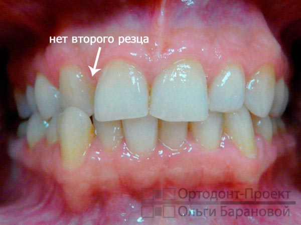 адентия зуба, неправильный прикус