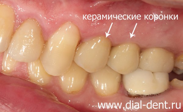 комплексное лечение и протезирование зубов керамикой