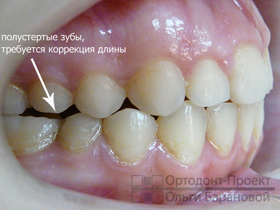 вид справа результат ортодонтического лечения