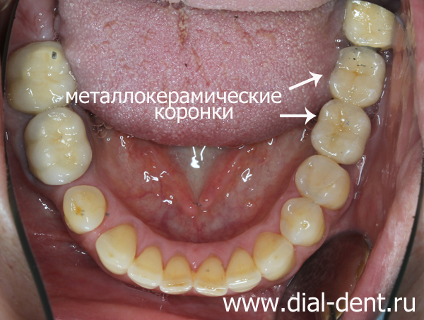 нижние зубы после протезирования на имплантах