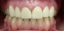 вид зубов спереди после лечения зубов