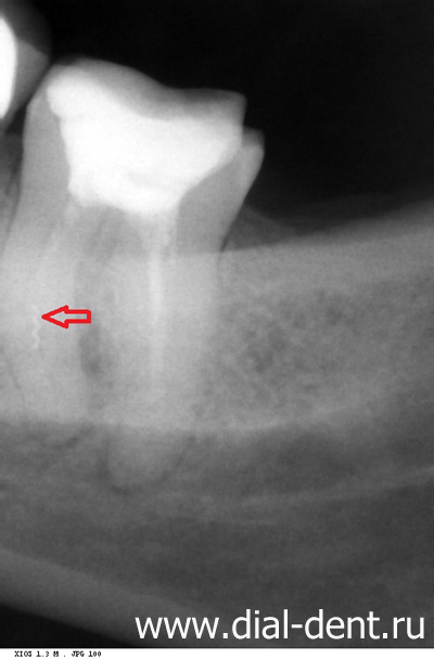 рентген зуба, виден фрагмент инструмента