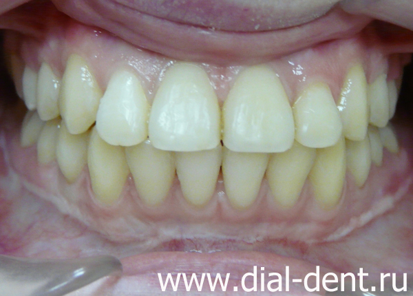 результат ортодонтического лечения, зуб сохранен