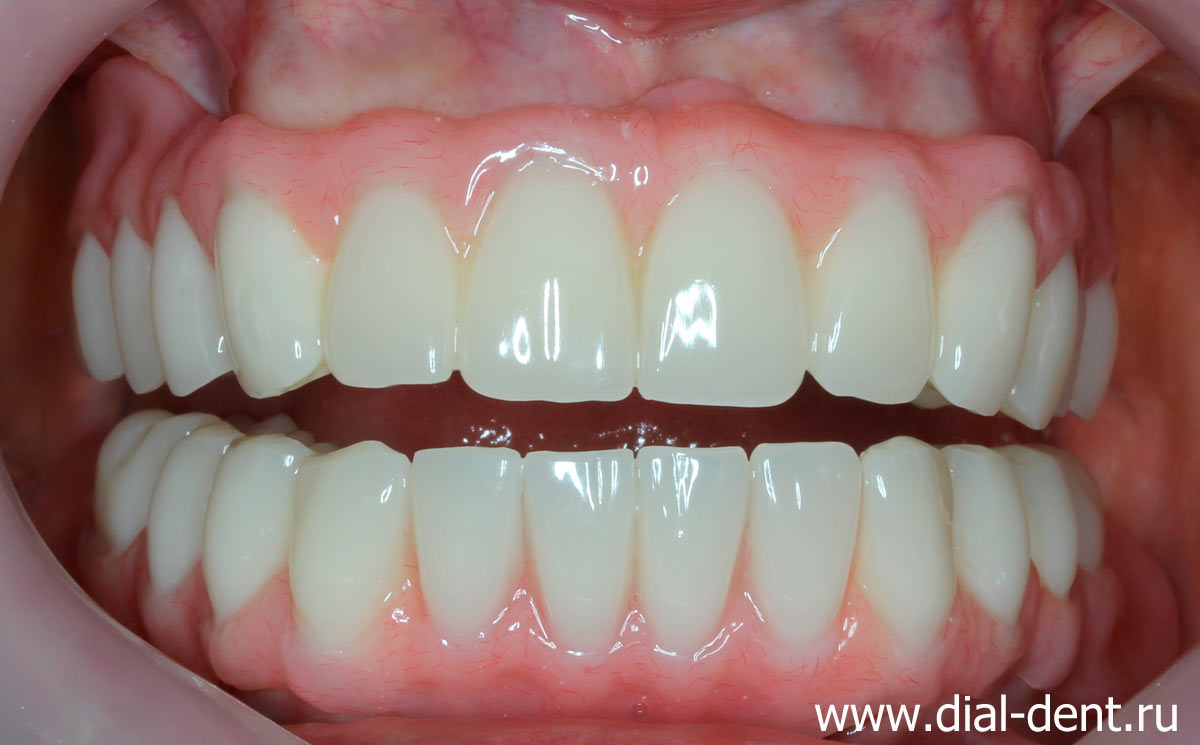 протезирование зубов от специалистов Диал-Дент