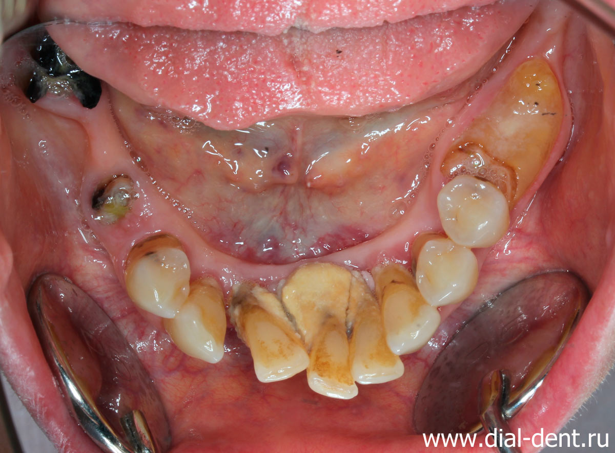 пародонтит, отсутствие зубов - верхняя челюсть до лечения