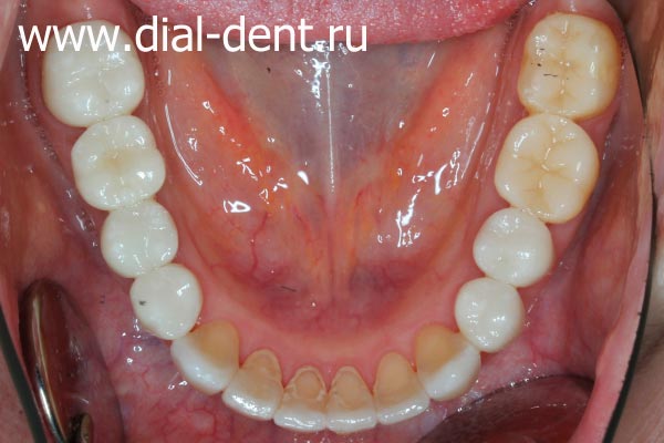 Протезирование зубов закончено! Такой прекрасный результат можно получить только при исправлении прикуса и последующей зубной имплантации и протезировании. 