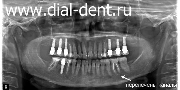 панорамный снимок зубов после лечения и имплантации