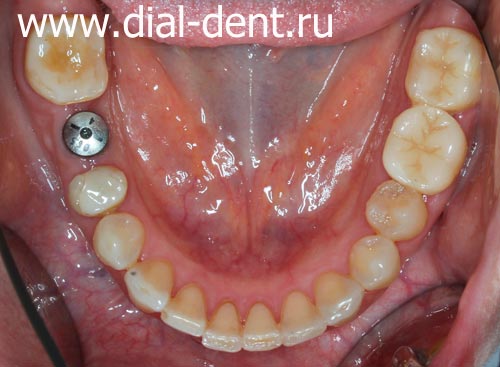 зубной имплант Astra Tech