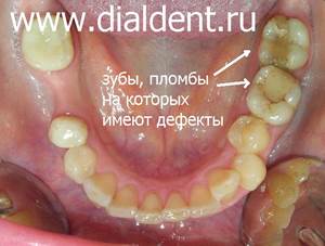 старые пломбы на нижних зубах, в одном из зубов плохо пролеченные каналы