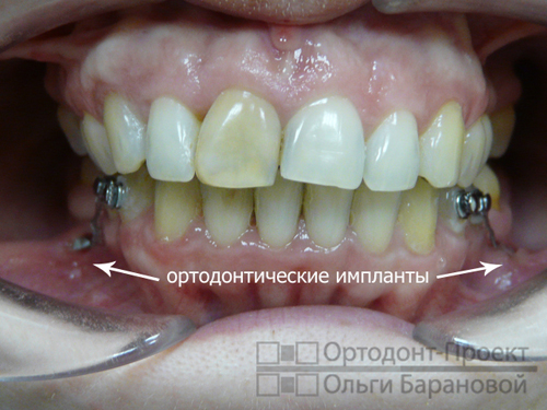 ортодонтические импланты установлены для создания правильной тяги