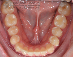нижние зубы после ортодонтического лечения капами Invisalign