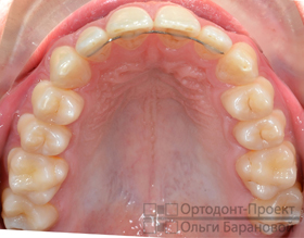 верхние зубы после ортодонтического лечения капами Invisalign