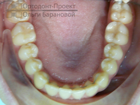 нижние зубы после комплексного ортодонтического лечения