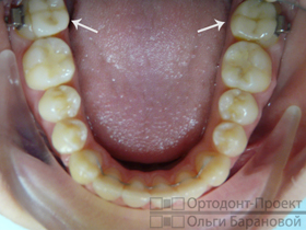 нижние зубы с несъемным ортотиком