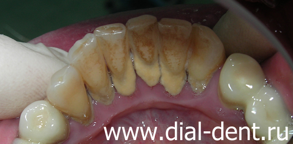 сильное скопление зубного камна на нижних зубах