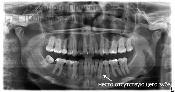 панорамный снимок зубов до ортодонтического лечения