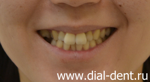 улыбка до лечения у ортодонта