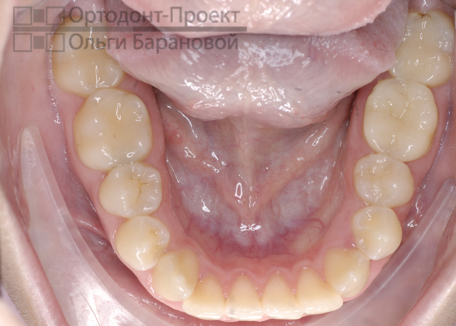 нижние зубы до ортодонтического лечения
