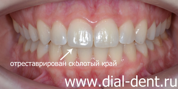 зубы выровнены, проведена коррекция скола переднего зуба