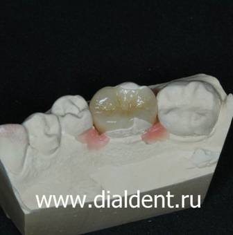 керамическая вкладка в зуб на модели