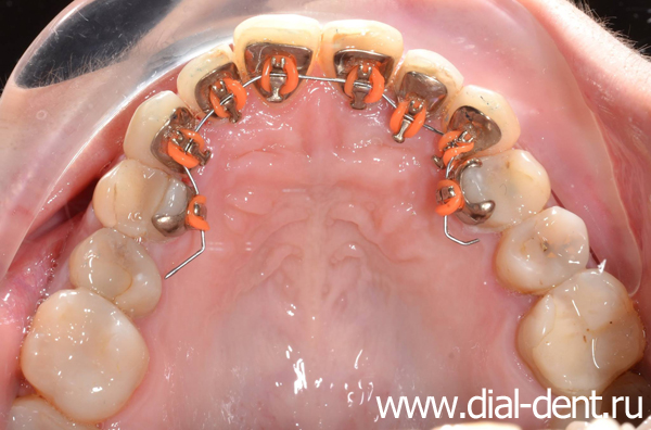 брекет-система Incognito Lite на верхних зубах