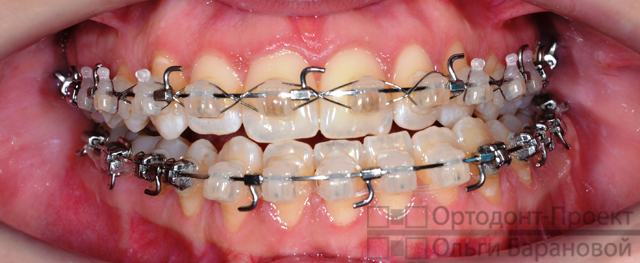 зубные ряды подготовлены к операции по исправлению прикуса