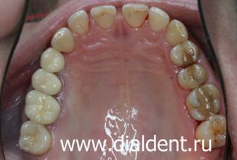выполнено повторное протезирование зубов керамическими коронками (в том числе протезирование на импланте) и устранение скола зуба