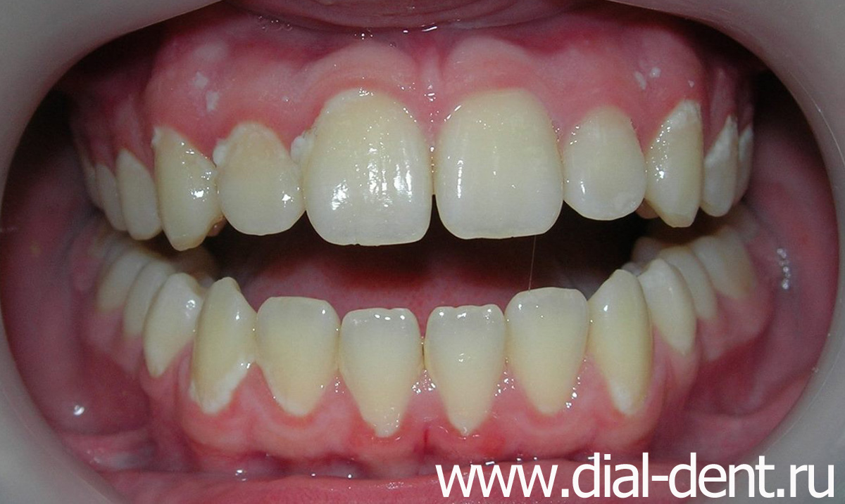сильное скопление зубного налета из-за плохой гигиены рта