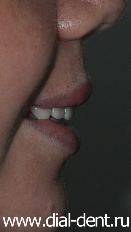 коронки из керамики E.max на передних верхних зубах