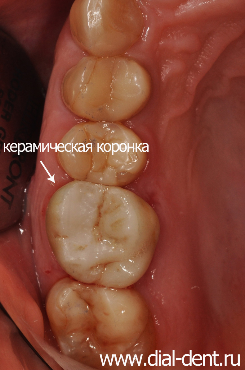 после лечения пульпита зуб закрыт керамической коронкой