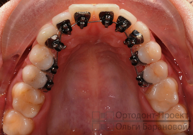 частичная брекет система WIN на нижних зубах