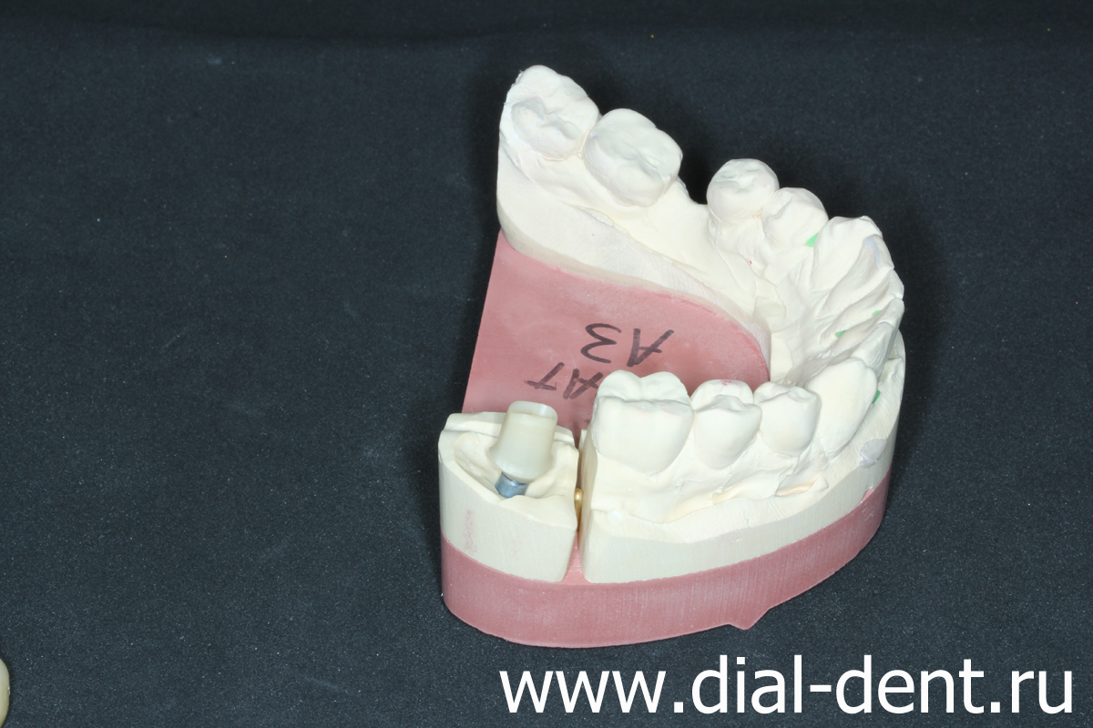 протезирование зуба на импланте, лаборатория Диал-Дент