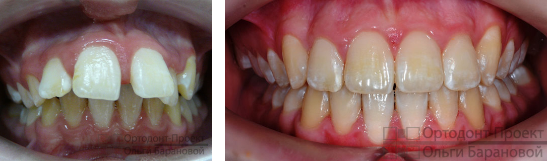 вид зубов до и после ортодонтического лечения