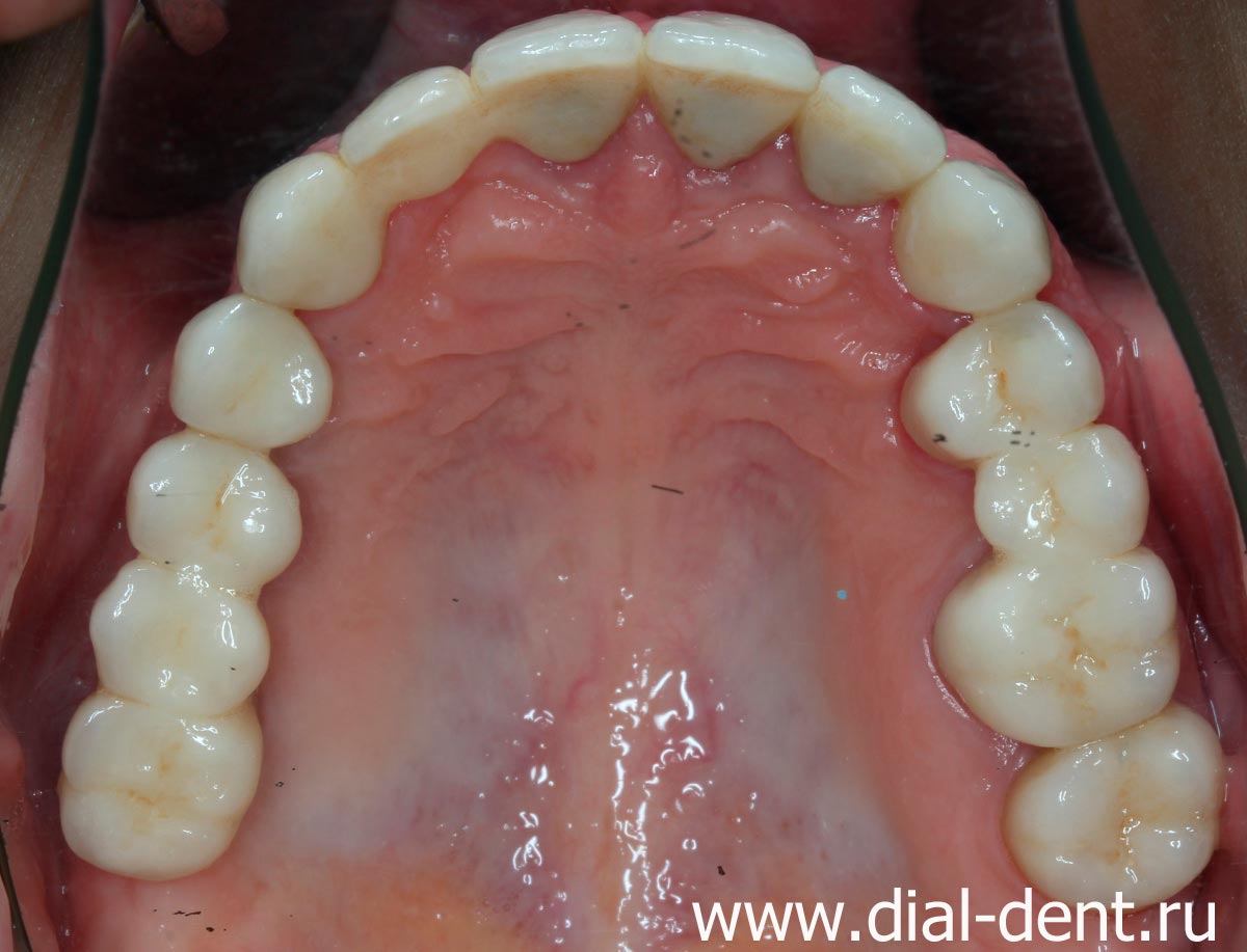 верхние зубы после комплексного лечения и протезирования зубов в Диал-Дент