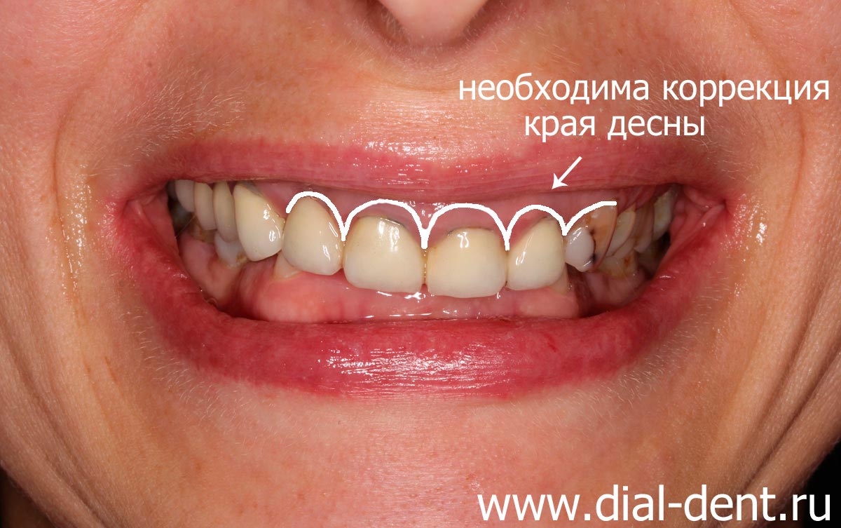 предлагается коррекция десневого края для изменения пропорций передних зубов