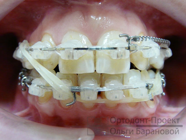 закрытие щели между зубами