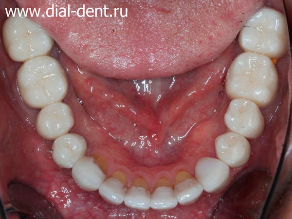 нижние зубы после лечения и протезирования
