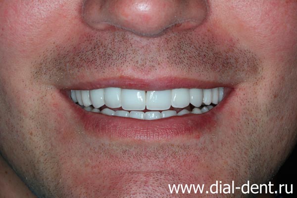 улыбка после лечения и протезирования зубов в Диал-Дент