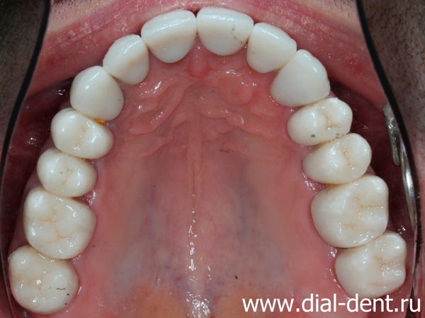 верхние зубы после лечения и протезирования
