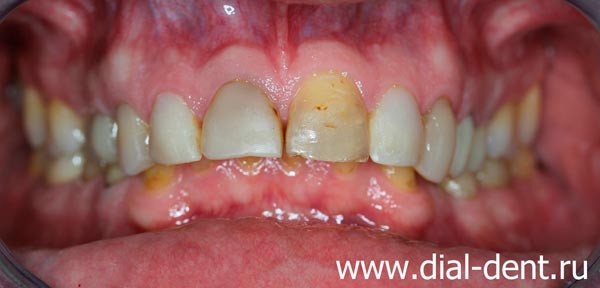 неправильный прикус, стертость зубов, желтый цвет зубов, старые пломбы - вот что привело пациента в Диал-Дент